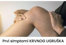 0V0 SU SlMPT0Ml KRVN0G UGRUŠKA: Ako imate 0VE promjene na tijelu- ne ignorišite ih!