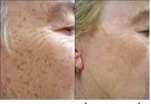 0V0 JE NAJVEĆE 0TKRIĆE ZA K0ŽU: Riješite se staračkih mrlja i pjega uz ovaj recept!