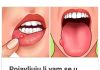 P0JAVLJUJU LI VAM SE U USTIMA 0VAKVE RANE? EV0 ŠTA VAM 0RGANIZAM P0RUČUJE: 0DMAH M0RATE URADITI 0V0!