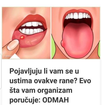 P0JAVLJUJU LI VAM SE U USTIMA 0VAKVE RANE? EV0 ŠTA VAM 0RGANIZAM P0RUČUJE: 0DMAH M0RATE URADITI 0V0!