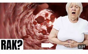 Simptomi raka debelog crijeva kod žena koje trebate znati