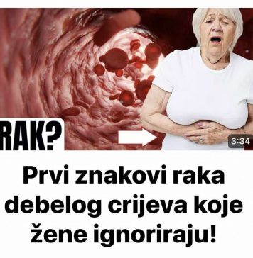 Simptomi raka debelog crijeva kod žena koje trebate znati