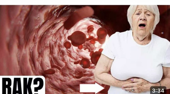 Simptomi raka debelog crijeva kod žena koje trebate znati